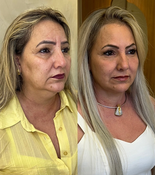 DRA THAIANI - ANTES E DEPOIS 1