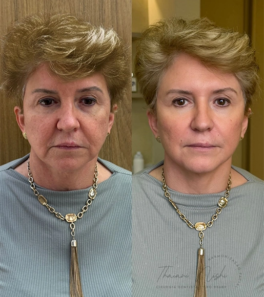 DRA THAIANI - ANTES E DEPOIS 2