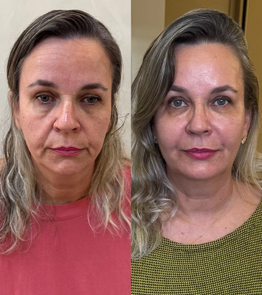 DRA THAIANI - ANTES E DEPOIS 3