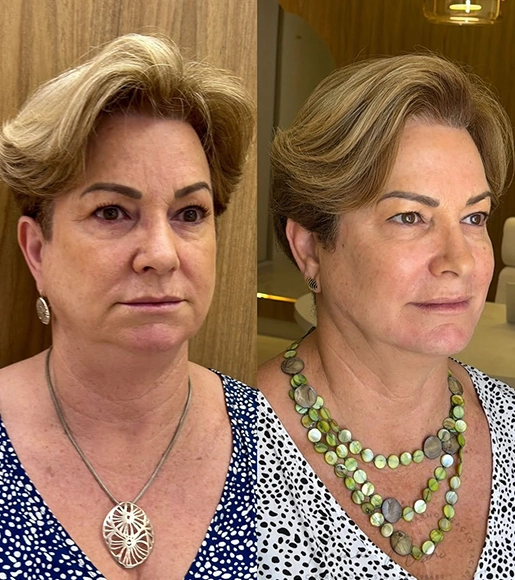 DRA THAIANI - ANTES E DEPOIS 5
